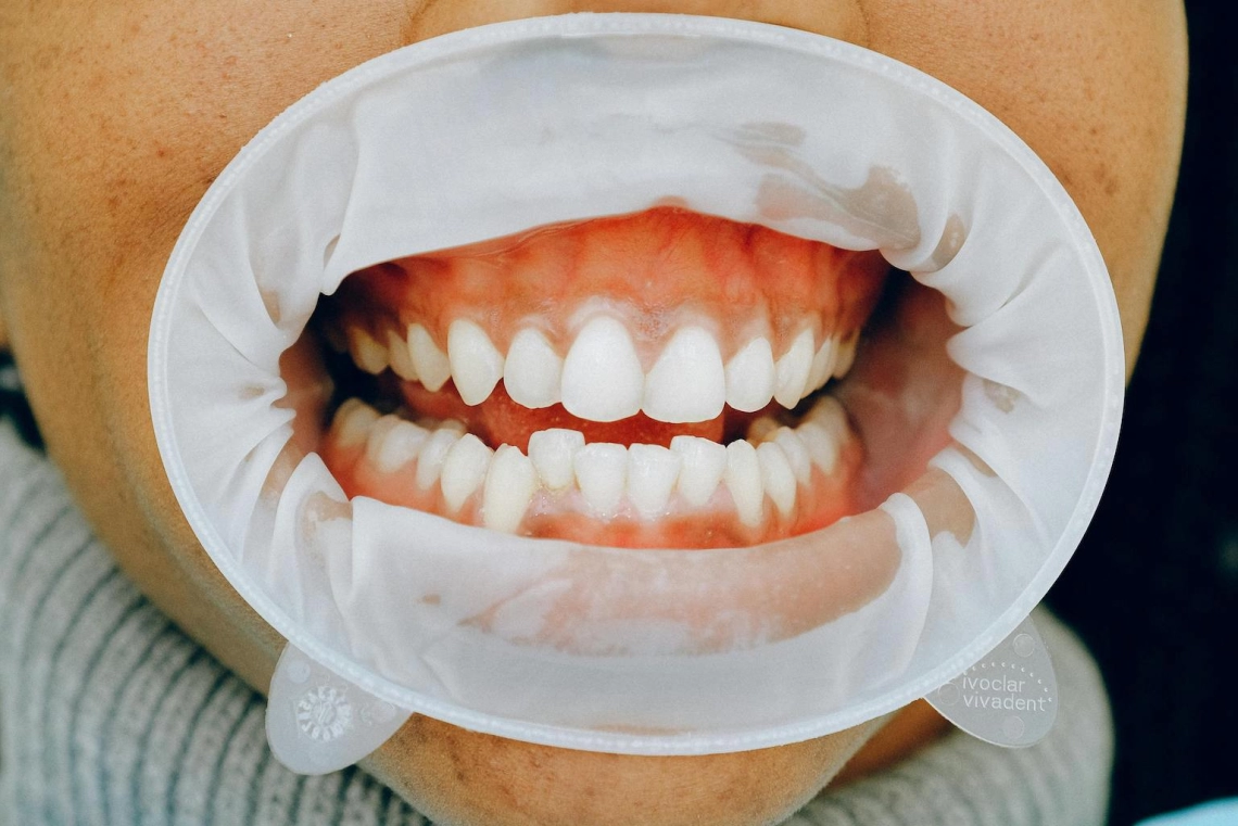 What is the best method of teeth whitening?