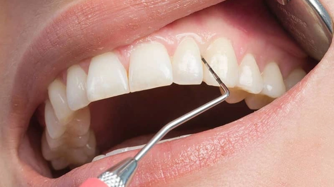 Periodontitis treatment